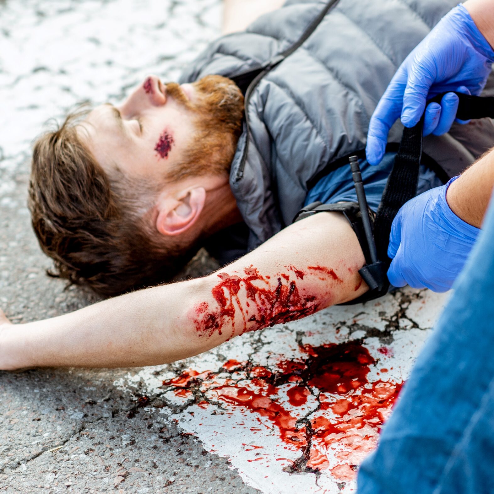 Applying first aid to the injured bleeding man, wearing tourniquet on the arm after the road accident on the pedestrian crossing